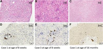 Neonatal cholestasis as the onset symptom of McCune–Albright syndrome: case reports and a literature review